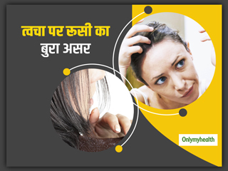 बाल हीं नहीं आपकी स्किन को भी नुकसान पहुंचा सकता है डैंड्रफ, जानें डैंड्रफ से छुटकारा पाने के तरीके